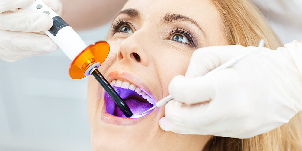 Dental Bonding Castle Rock