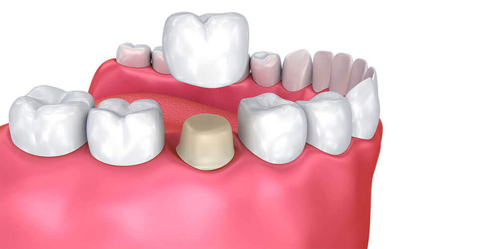 Dental Crowns Castle Rock