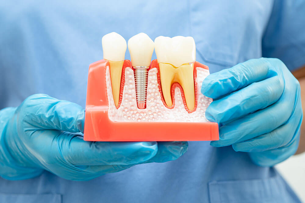 Dental Implants Castle Rock