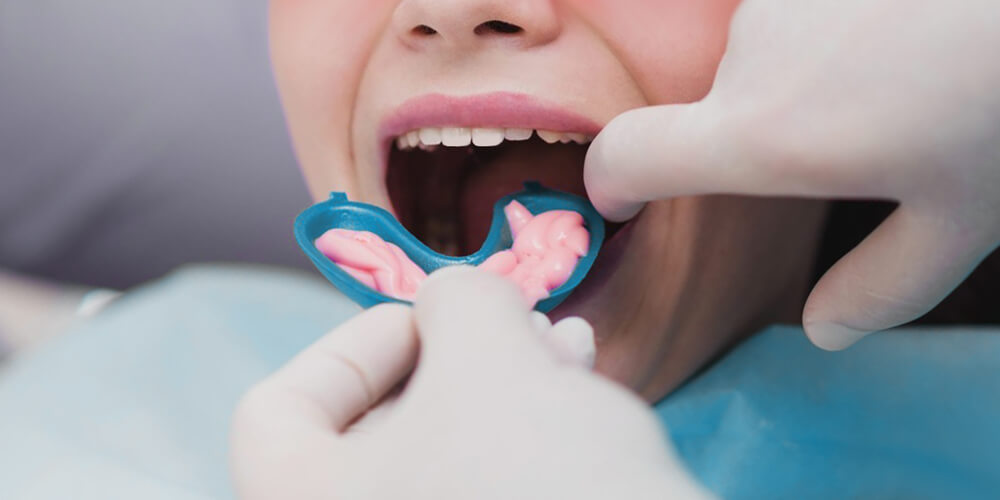 Fluoride Treatment Castle Rock
