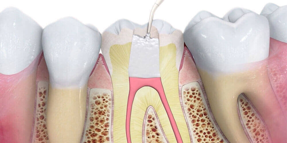 Root Canal Treatment Castle Rock