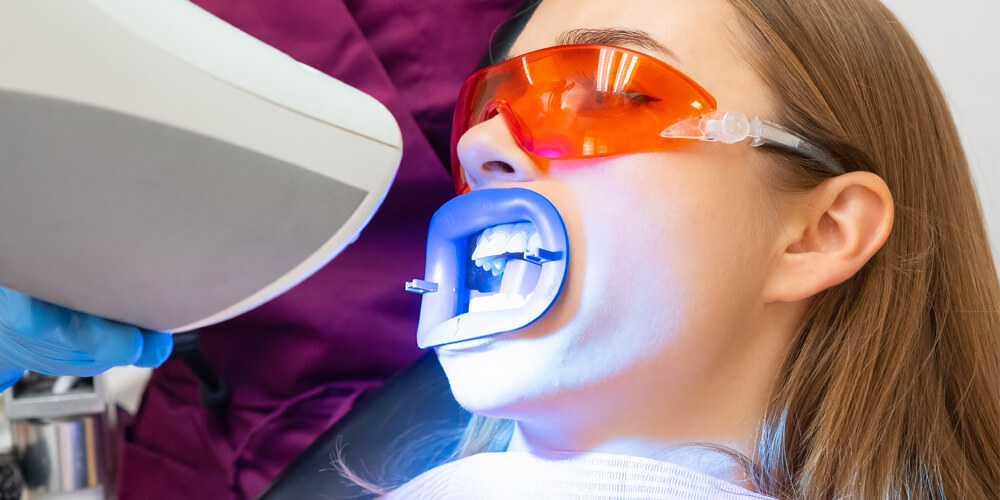 Teeth Whitening Castle Rock